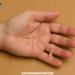 Understanding Loguytren Problems (Dupuytren’s Contracture): Causes, Symptoms, and Solutions Loguytren Problems